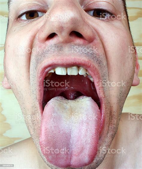 Bacterial Infection Disease Tongue Stock Photo Download Image Now