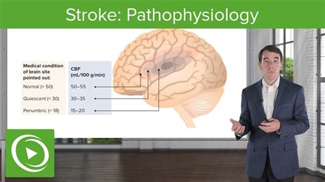 Stroke Pathophysiology Clinical Neurology Youtube