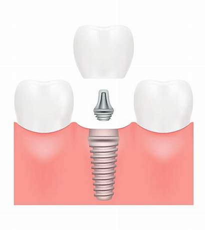 Dental Implants Implant Types Crest Placement Root