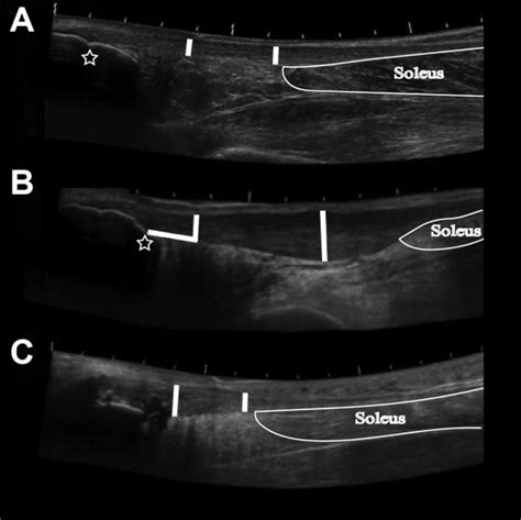 Representative Ultrasound Images For Measuring Achilles Tendon
