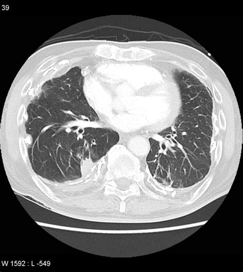 Asbestos Related Lung And Pleural Disease Image
