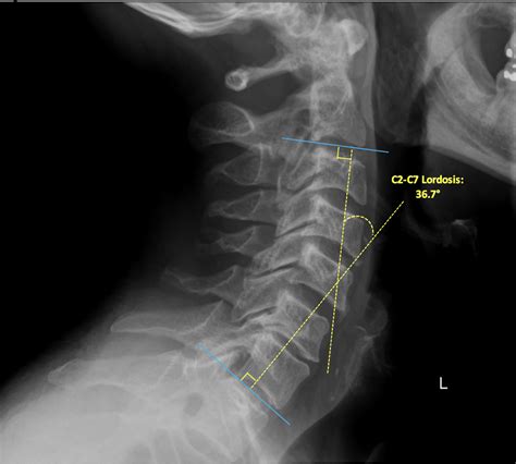 Subaxial Cervical Spine Plain Radiographs Radiology Key