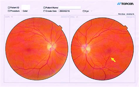 Color Fundus Photographs Of The Right Eye Od And Left Eye Os