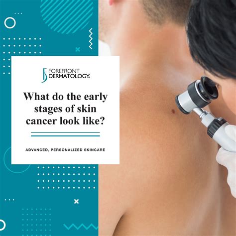What Do The Early Stages Of Skin Cancer Look Like Forefront