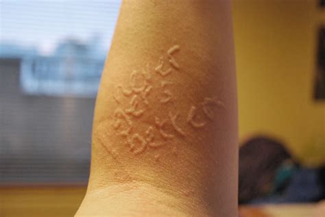 Dermatographic Urticaria Skin Writing Flickr