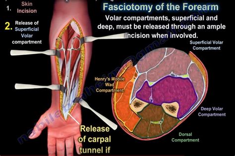 Compartment Syndrome Of Forearm —