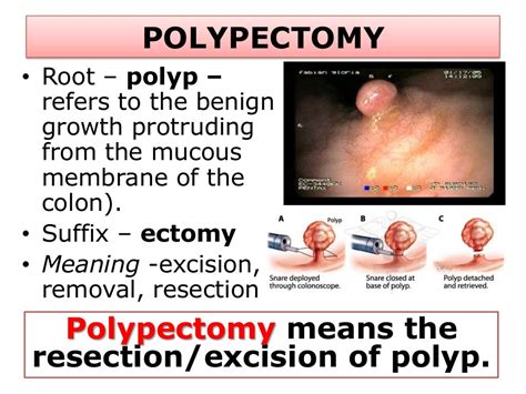 Colonoscopy With Polypectomy