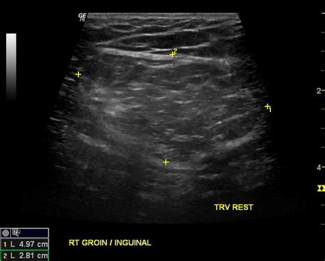 Scrotal Hernia Ultrasound