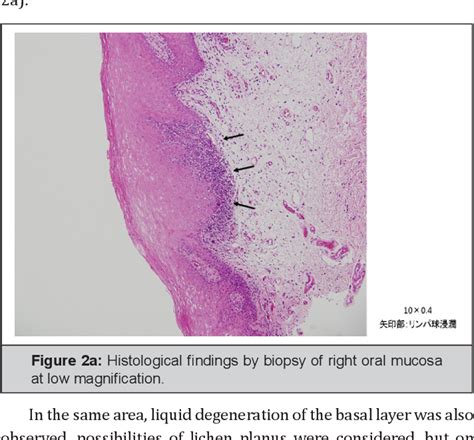 Figure 2 From A Case Of Oral Leukoplakia Recovered By Receiving Hrt For