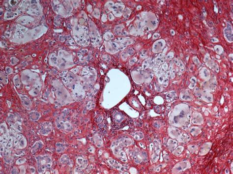 Widespread Giant Cell Transformation Of Hepatocytes In Gch Aha