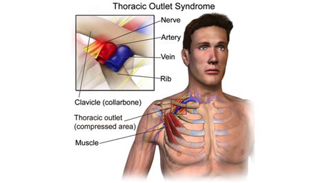 Thoracic Outlet Syndrome As Related To Shoulder Injuries And Disorders