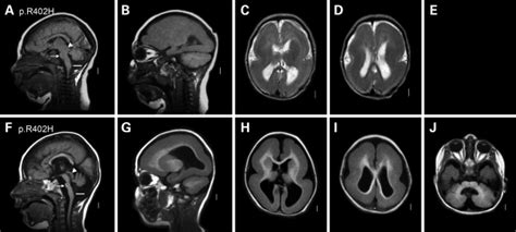 Tuba1a Mutations Cause Wide Spectrum Lissencephaly Smooth Brain And