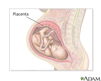 Placenta Abruptio Information Mount Sinai New York