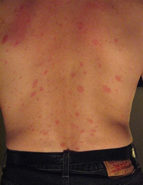 Pityriasis Rosea E Learning Mit Lecturio