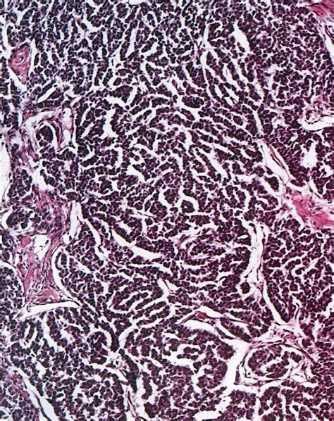Pathology Outlines Granulosa Cell Tumor Adult