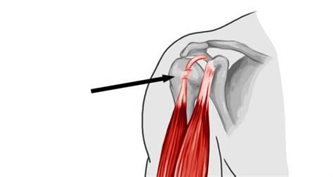 Long Head Bicep Tendon Tear At Shoulder Causes Symptoms And Treatments Steel Tendon