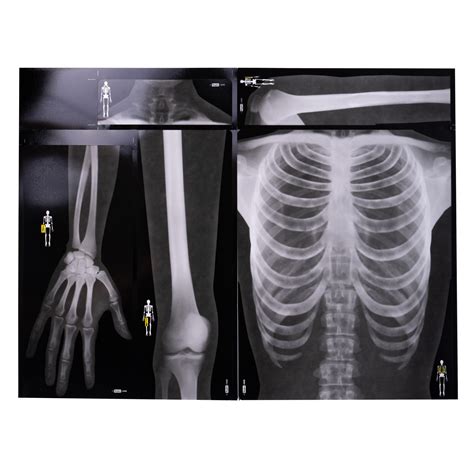 röntgen bilder mensch knochen skelett rolf sw 383 2004