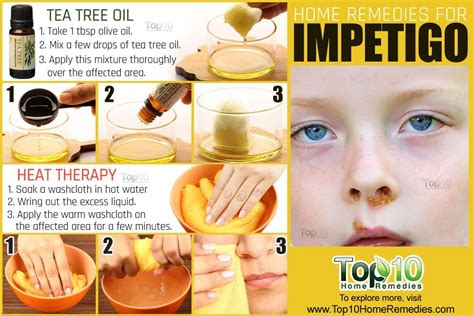 Impetigo Home Remedies Prevention And When To See A Doctor
