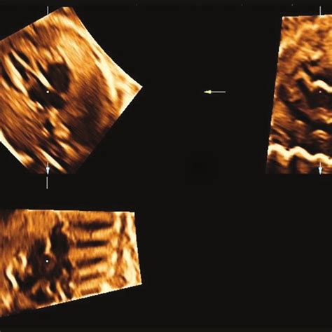 20 Tomographic Ultrasound Imaging In A Stic Volume In Diastole In A