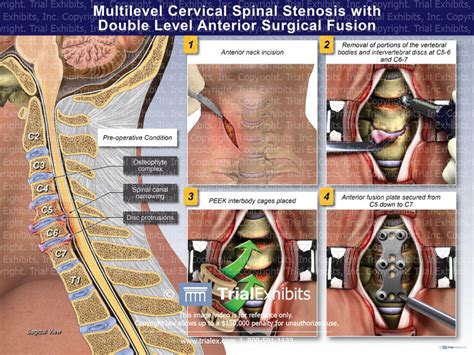 Multilevel Cervical Spinal Stenosis Wit Double Level Anterior Surgical