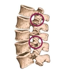 Sindrome Delle Faccette Articolari Guida Completa Ryakos