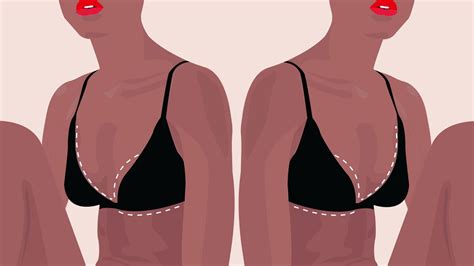 Breast Reduction Surgery Guide What To Expect From Cost To Recovery Time Allure