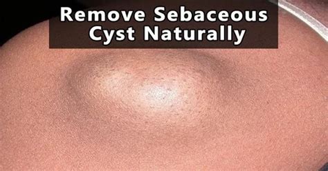 5 Ways To Remove That Nasty Sebaceous Cyst Using Homemade Remedies