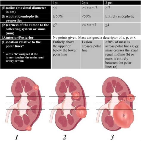 Renal Score External Validation Of The Simplified Padua Renal Spare