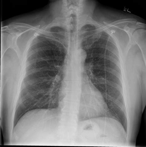 File Chest X Ray Posteroanterior View Wikimedia Commons