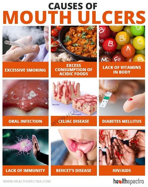 And can anything relieve the pain? 20 Effective Natural Remedies For Mouth Ulcers you Need to ...