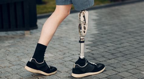 Adjusting To Life With An Artificial Limb