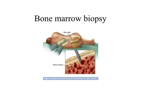 Bone Marrow Biopsy Anatomy