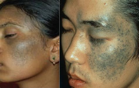 Mongolian Birthmarkspot On Babies Meaning Pictures Myths Removal