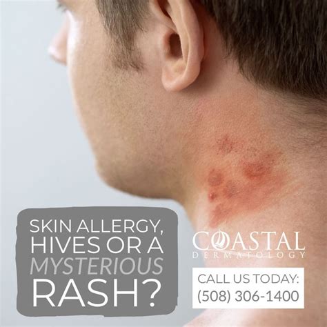 When You Get Hit With A Skin Allergy Hives Or A Rash We Can Help