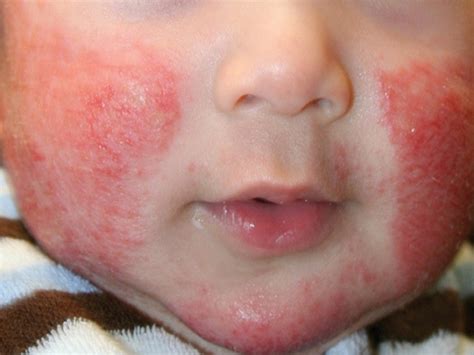 Contact dermatitis is a type of inflammation of the skin. Allergic Contact Dermatitis - Types, Causes & Treatments