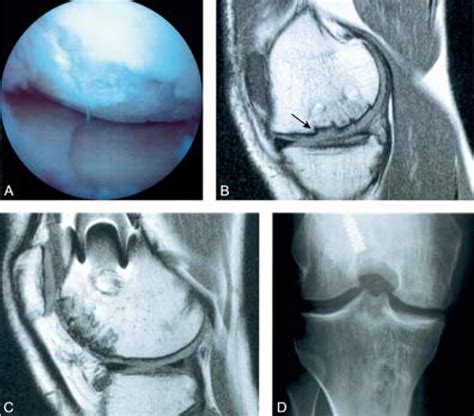 Arthroscopic Treatment Of Medial Femoral Knee Osteochondral Defect My XXX Hot Girl