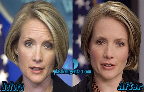 Dana Perino Plastic Surgery Before And After