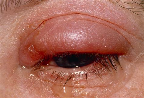Swollen Red Eye With Conjunctivitis Stock Image M1550241