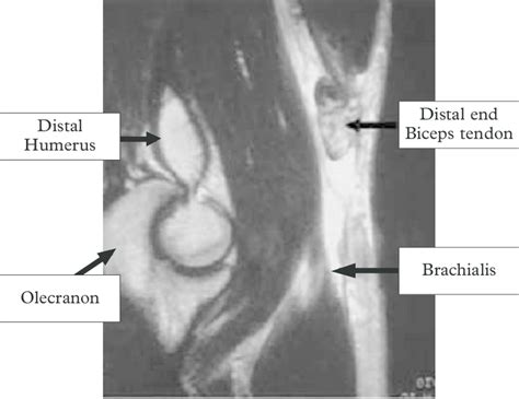 Mri Ruptured Biceps Tendon Download Scientific Diagram