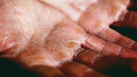 Vesicular Hand And Foot Dermatitis Dr Maksym Breslavets