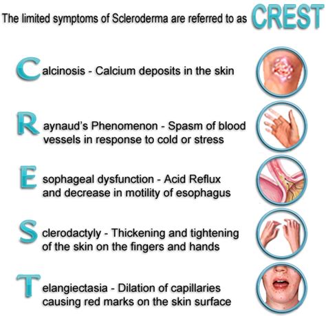 Pin On Crest Syndrome Scleroderma