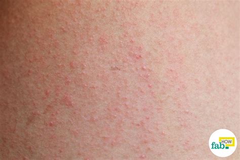 How To Treat Keratosis Pilaris Chicken Skin Fab How