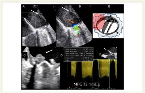 Mechanical Valve In Mitral Position And Thrombus Obstruction Increased