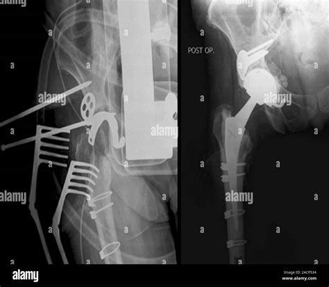Total Hip Replacement X Rays Taken During Left And After Right