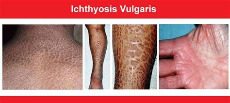 Ichthyosis Vulgaris Chandigarh Ayurved And Panchkarma Centre
