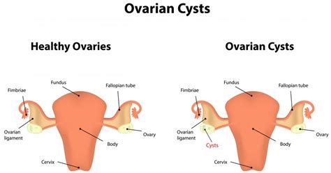 what is a complex ovarian cyst with pictures