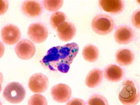 Green Neutrophil Inclusions In A Patient With Liver Disease