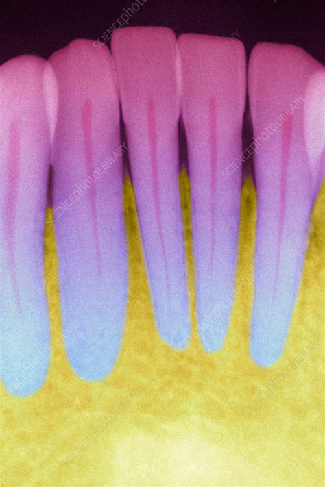 Colourized Dental X Ray Stock Image P4860103 Science Photo Library