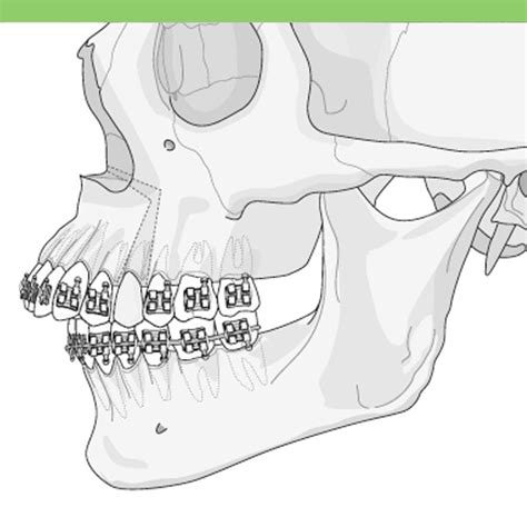 Maxillary Osteotomy Costa Rica Dental Guide To Best Dentists