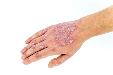 Risankizumab Bla Submitted For Moderate To Severe Plaque Psoriasis